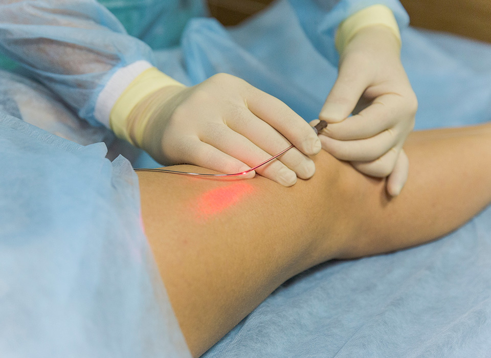 Endovenous-Laser-Treatment-EVLT