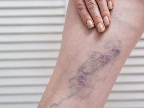 Varicose Vein
