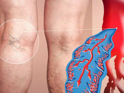 Leg Varicose vein