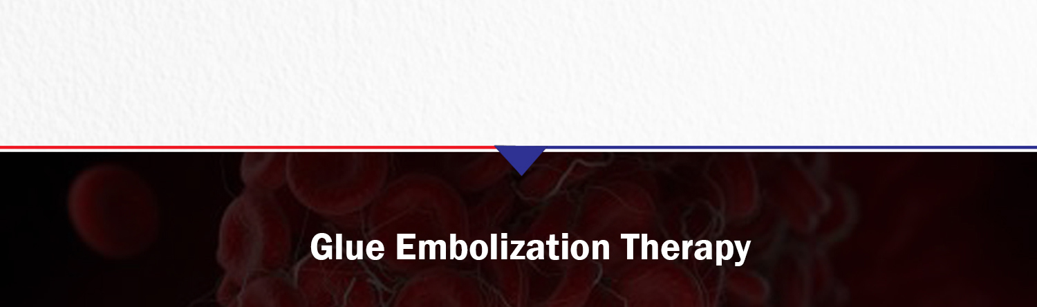 Glue Embolization Therapy